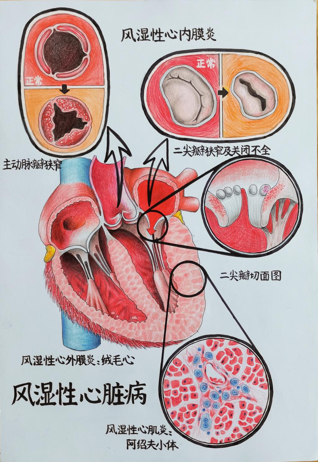 2. 邮寄手绘 作品分类 2 风湿性心脏病 600全讯白菜官方网站 张晨彤
